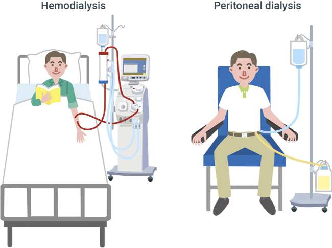 What Is The Difference Between Hemodialysis And Peritoneal Dialysis Quizlet